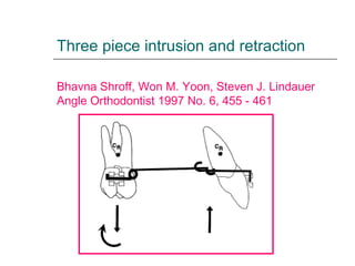 Three piece intrusion and retraction
Bhavna Shroff, Won M. Yoon, Steven J. Lindauer
Angle Orthodontist 1997 No. 6, 455 - 461
 