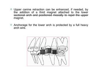  Upper canine retraction can be enhanced, if needed, by
the addition of a third magnet attached to the lower
sectional arch and positioned mesially to repel the upper
magnet.
 Anchorage for the lower arch is protected by a full heavy
arch wire.
 