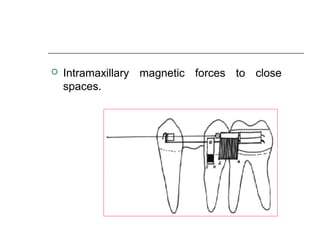  Intramaxillary magnetic forces to close
spaces.
 