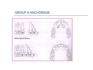 GROUP A ANCHORAGE
 