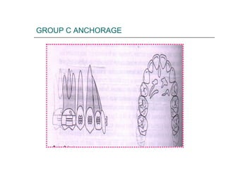 GROUP C ANCHORAGE
 