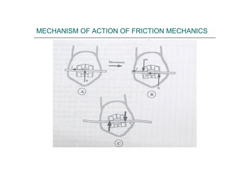 MECHANISM OF ACTION OF FRICTION MECHANICS
 