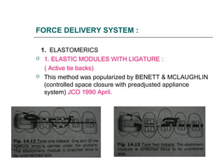 FORCE DELIVERY SYSTEM :
1. ELASTOMERICS
 1. ELASTIC MODULES WITH LIGATURE :
( Active tie backs)
 This method was popularized by BENETT & MCLAUGHLIN
(controlled space closure with preadjusted appliance
system) JCO 1990 April.
 