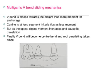  Mulligan’s V bend sliding mechanics
 V bend is placed towards the molars thus more moment for
anchorage
 Canine is at long segment initially tips as less moment
 But as the space closes moment increases and cause its
translation
 Finally V bend will become centre bend and root paralleling takes
place
 