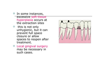  In some instances,
excessive soft-tissue
hyperplasia occurs at
the extraction sites
 this is not only
unhygienic, but it can
prevent full space
closure or allow
spaces to reopen after
treatment.
 Local gingival surgery
may be necessary in
such cases.
 