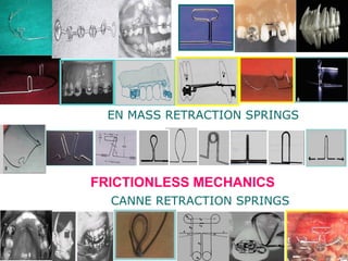 FRICTIONLESS MECHANICS
CANNE RETRACTION SPRINGS
EN MASS RETRACTION SPRINGS
 