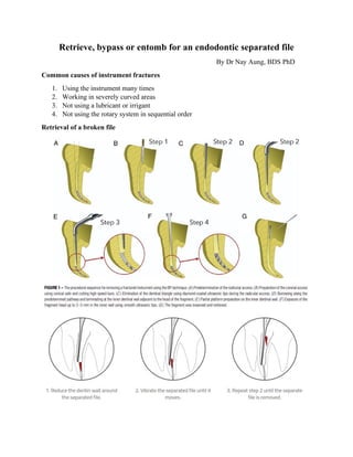Retrieve, bypass or entomb for an endodontic separated file
By Dr Nay Aung, BDS PhD
Common causes of instrument fractures
1. Using the instrument many times
2. Working in severely curved areas
3. Not using a lubricant or irrigant
4. Not using the rotary system in sequential order
Retrieval of a broken file
 