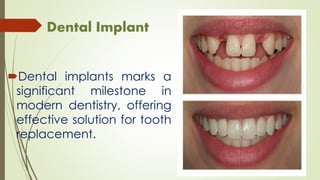 Dental Implant
Dental implants marks a
significant milestone in
modern dentistry, offering
effective solution for tooth
replacement.
 