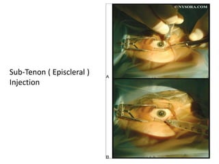 Sub-Tenon ( Episcleral )
Injection
 