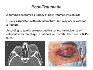 Post-Traumatic
A common presumed etiology of post-traumatic vision loss
Usually associated with orbital fractures but may occur without
a fracture
According to two large retrospective series, the incidence of
retrobulbar hemorrhage in patients with orbital fractures is 0.45 -
0.6%.
R
 