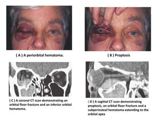 ( A ) A periorbital hematoma. ( B ) Proptosis
( C ) A coronal CT scan demonstrating an
orbital floor fracture and an inferior orbital
hematoma.
( D ) A sagittal CT scan demonstrating
proptosis, an orbital floor fracture and a
subperiosteal hematoma extending to the
orbital apex
 