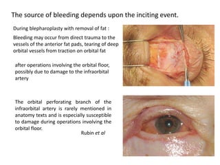 The source of bleeding depends upon the inciting event.
During blepharoplasty with removal of fat :
Bleeding may occur from direct trauma to the
vessels of the anterior fat pads, tearing of deep
orbital vessels from traction on orbital fat
after operations involving the orbital floor,
possibly due to damage to the infraorbital
artery
The orbital perforating branch of the
infraorbital artery is rarely mentioned in
anatomy texts and is especially susceptible
to damage during operations involving the
orbital floor.
Rubin et al
 