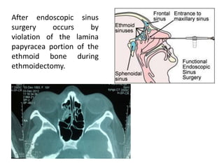 After endoscopic sinus
surgery occurs by
violation of the lamina
papyracea portion of the
ethmoid bone during
ethmoidectomy.
 