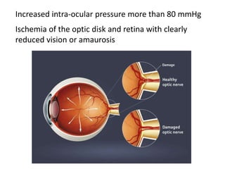 Ischemia of the optic disk and retina with clearly
reduced vision or amaurosis
Increased intra-ocular pressure more than 80 mmHg
 