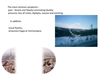 The most common symptoms :
pain : Severe and Steady Lancinating Quality
pressure, loss of vision, diplopia, nausea and vomiting
In addition
visual flashes,
amaurosis fugax or hemianopsia
 
