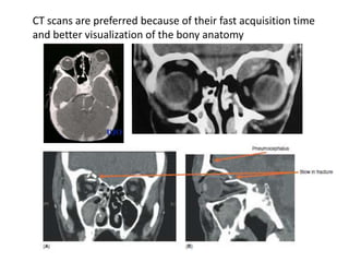 CT scans are preferred because of their fast acquisition time
and better visualization of the bony anatomy
 