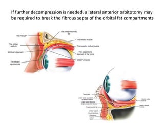 If further decompression is needed, a lateral anterior orbitotomy may
be required to break the fibrous septa of the orbital fat compartments
 