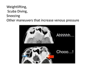 Weightlifting,
Scuba Diving,
Sneezing
Other maneuvers that increase venous pressure
 