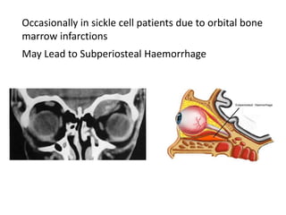 Occasionally in sickle cell patients due to orbital bone
marrow infarctions
May Lead to Subperiosteal Haemorrhage
 