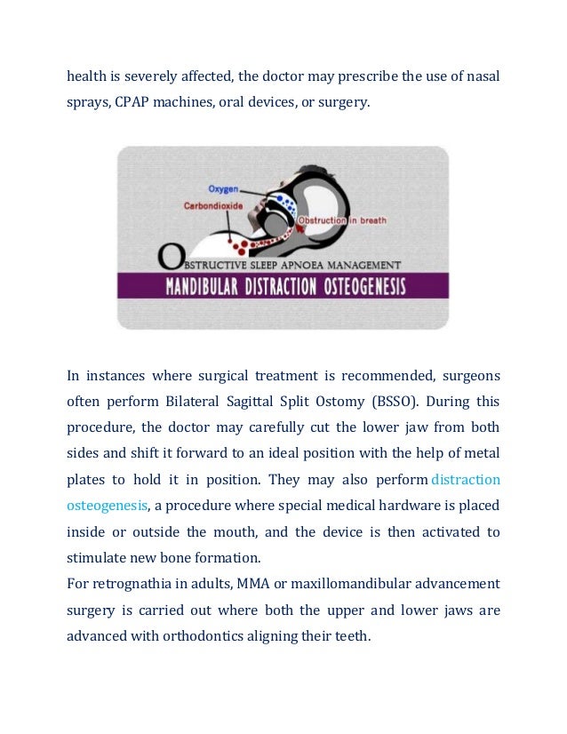 health is severely affected, the doctor may prescribe the use of nasal
sprays, CPAP machines, oral devices, or surgery.
In instances where surgical treatment is recommended, surgeons
often perform Bilateral Sagittal Split Ostomy (BSSO). During this
procedure, the doctor may carefully cut the lower jaw from both
sides and shift it forward to an ideal position with the help of metal
plates to hold it in position. They may also perform distraction
osteogenesis, a procedure where special medical hardware is placed
inside or outside the mouth, and the device is then activated to
stimulate new bone formation.
For retrognathia in adults, MMA or maxillomandibular advancement
surgery is carried out where both the upper and lower jaws are
advanced with orthodontics aligning their teeth.
 