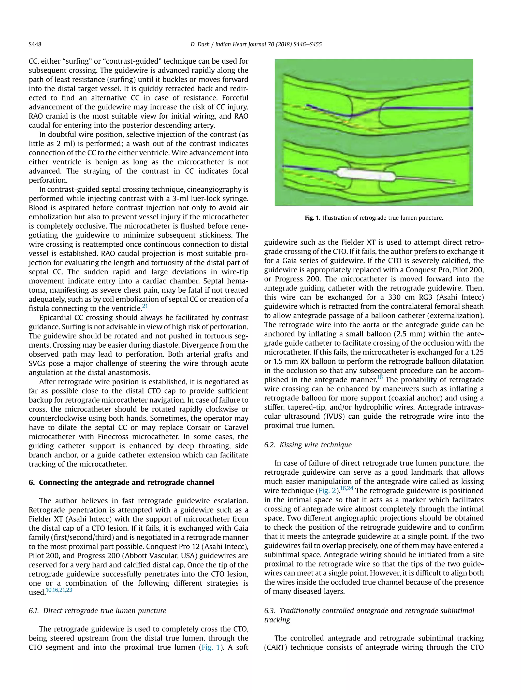 CC, either “surﬁng” or “contrast-guided” technique can be used for
subsequent crossing. The guidewire is advanced rapidly along the
path of least resistance (surﬁng) until it buckles or moves forward
into the distal target vessel. It is quickly retracted back and redir-
ected to ﬁnd an alternative CC in case of resistance. Forceful
advancement of the guidewire may increase the risk of CC injury.
RAO cranial is the most suitable view for initial wiring, and RAO
caudal for entering into the posterior descending artery.
In doubtful wire position, selective injection of the contrast (as
little as 2 ml) is performed; a wash out of the contrast indicates
connection of the CC to the either ventricle. Wire advancement into
either ventricle is benign as long as the microcatheter is not
advanced. The straying of the contrast in CC indicates focal
perforation.
In contrast-guided septal crossing technique, cineangiography is
performed while injecting contrast with a 3-ml luer-lock syringe.
Blood is aspirated before contrast injection not only to avoid air
embolization but also to prevent vessel injury if the microcatheter
is completely occlusive. The microcatheter is ﬂushed before rene-
gotiating the guidewire to minimize subsequent stickiness. The
wire crossing is reattempted once continuous connection to distal
vessel is established. RAO caudal projection is most suitable pro-
jection for evaluating the length and tortuosity of the distal part of
septal CC. The sudden rapid and large deviations in wire-tip
movement indicate entry into a cardiac chamber. Septal hema-
toma, manifesting as severe chest pain, may be fatal if not treated
adequately, such as by coil embolization of septal CC or creation of a
ﬁstula connecting to the ventricle.21
Epicardial CC crossing should always be facilitated by contrast
guidance. Surﬁng is not advisable in view of high risk of perforation.
The guidewire should be rotated and not pushed in tortuous seg-
ments. Crossing may be easier during diastole. Divergence from the
observed path may lead to perforation. Both arterial grafts and
SVGs pose a major challenge of steering the wire through acute
angulation at the distal anastomosis.
After retrograde wire position is established, it is negotiated as
far as possible close to the distal CTO cap to provide sufﬁcient
backup for retrograde microcatheter navigation. In case of failure to
cross, the microcatheter should be rotated rapidly clockwise or
counterclockwise using both hands. Sometimes, the operator may
have to dilate the septal CC or may replace Corsair or Caravel
microcatheter with Finecross microcatheter. In some cases, the
guiding catheter support is enhanced by deep throating, side
branch anchor, or a guide catheter extension which can facilitate
tracking of the microcatheter.
6. Connecting the antegrade and retrograde channel
The author believes in fast retrograde guidewire escalation.
Retrograde penetration is attempted with a guidewire such as a
Fielder XT (Asahi Intecc) with the support of microcatheter from
the distal cap of a CTO lesion. If it fails, it is exchanged with Gaia
family (ﬁrst/second/third) and is negotiated in a retrograde manner
to the most proximal part possible. Conquest Pro 12 (Asahi Intecc),
Pilot 200, and Progress 200 (Abbott Vascular, USA) guidewires are
reserved for a very hard and calciﬁed distal cap. Once the tip of the
retrograde guidewire successfully penetrates into the CTO lesion,
one or a combination of the following different strategies is
used.10,16,21,23
6.1. Direct retrograde true lumen puncture
The retrograde guidewire is used to completely cross the CTO,
being steered upstream from the distal true lumen, through the
CTO segment and into the proximal true lumen (Fig. 1). A soft
guidewire such as the Fielder XT is used to attempt direct retro-
grade crossing of the CTO. If it fails, the author prefers to exchange it
for a Gaia series of guidewire. If the CTO is severely calciﬁed, the
guidewire is appropriately replaced with a Conquest Pro, Pilot 200,
or Progress 200. The microcatheter is moved forward into the
antegrade guiding catheter with the retrograde guidewire. Then,
this wire can be exchanged for a 330 cm RG3 (Asahi Intecc)
guidewire which is retracted from the contralateral femoral sheath
to allow antegrade passage of a balloon catheter (externalization).
The retrograde wire into the aorta or the antegrade guide can be
anchored by inﬂating a small balloon (2.5 mm) within the ante-
grade guide catheter to facilitate crossing of the occlusion with the
microcatheter. If this fails, the microcatheter is exchanged for a 1.25
or 1.5 mm RX balloon to perform the retrograde balloon dilatation
in the occlusion so that any subsequent procedure can be accom-
plished in the antegrade manner.16
The probability of retrograde
wire crossing can be enhanced by maneuvers such as inﬂating a
retrograde balloon for more support (coaxial anchor) and using a
stiffer, tapered-tip, and/or hydrophilic wires. Antegrade intravas-
cular ultrasound (IVUS) can guide the retrograde wire into the
proximal true lumen.
6.2. Kissing wire technique
In case of failure of direct retrograde true lumen puncture, the
retrograde guidewire can serve as a good landmark that allows
much easier manipulation of the antegrade wire called as kissing
wire technique (Fig. 2).16,24
The retrograde guidewire is positioned
in the intimal space so that it acts as a marker which facilitates
crossing of antegrade wire almost completely through the intimal
space. Two different angiographic projections should be obtained
to check the position of the retrograde guidewire and to conﬁrm
that it meets the antegrade guidewire at a single point. If the two
guidewires fail to overlap precisely, one of them may have entered a
subintimal space. Antegrade wiring should be initiated from a site
proximal to the retrograde wire so that the tips of the two guide-
wires can meet at a single point. However, it is difﬁcult to align both
the wires inside the occluded true channel because of the presence
of many diseased layers.
6.3. Traditionally controlled antegrade and retrograde subintimal
tracking
The controlled antegrade and retrograde subintimal tracking
(CART) technique consists of antegrade wiring through the CTO
Fig. 1. Illustration of retrograde true lumen puncture.
D. Dash / Indian Heart Journal 70 (2018) S446eS455S448
 