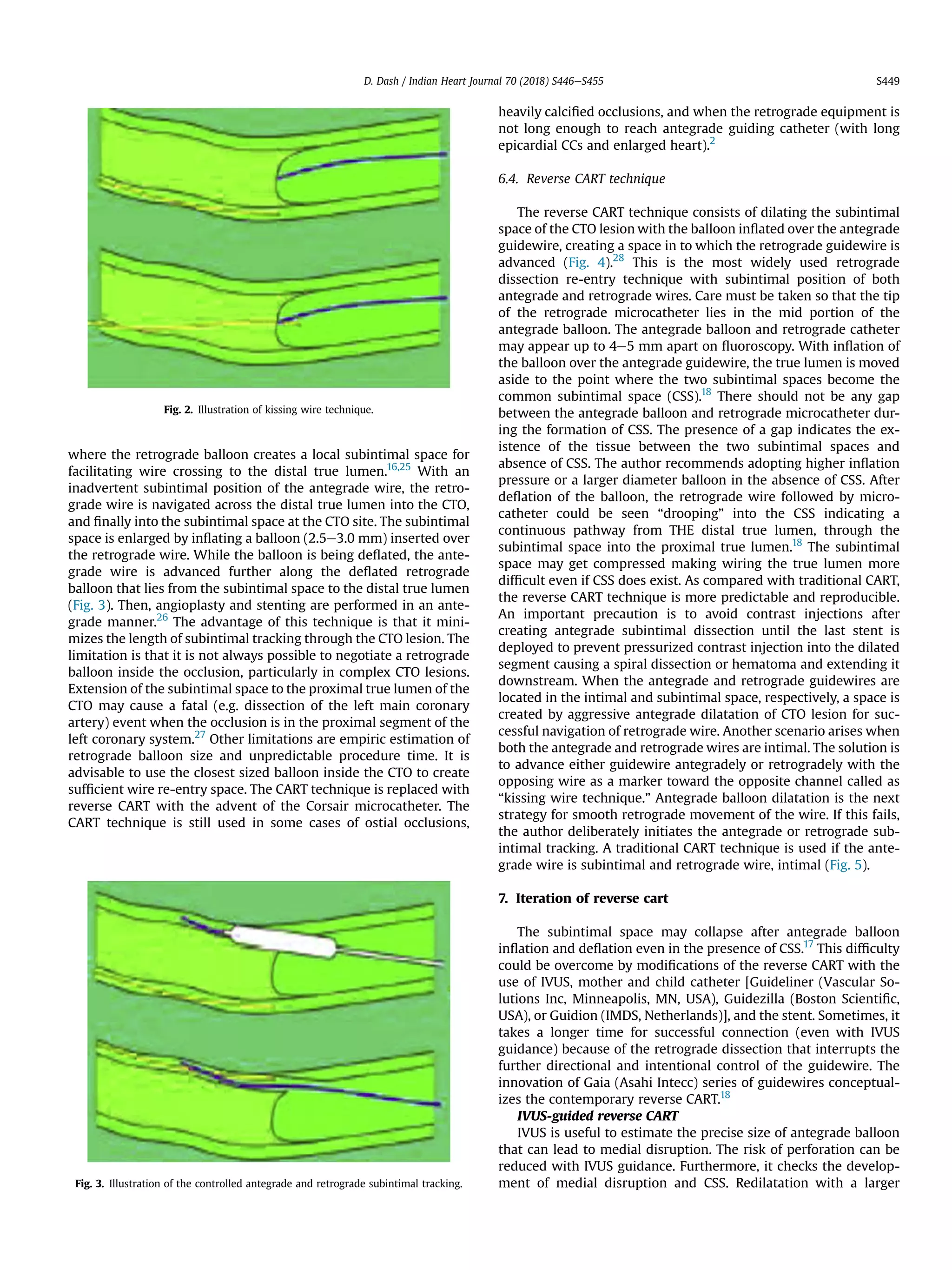 where the retrograde balloon creates a local subintimal space for
facilitating wire crossing to the distal true lumen.16,25
With an
inadvertent subintimal position of the antegrade wire, the retro-
grade wire is navigated across the distal true lumen into the CTO,
and ﬁnally into the subintimal space at the CTO site. The subintimal
space is enlarged by inﬂating a balloon (2.5e3.0 mm) inserted over
the retrograde wire. While the balloon is being deﬂated, the ante-
grade wire is advanced further along the deﬂated retrograde
balloon that lies from the subintimal space to the distal true lumen
(Fig. 3). Then, angioplasty and stenting are performed in an ante-
grade manner.26
The advantage of this technique is that it mini-
mizes the length of subintimal tracking through the CTO lesion. The
limitation is that it is not always possible to negotiate a retrograde
balloon inside the occlusion, particularly in complex CTO lesions.
Extension of the subintimal space to the proximal true lumen of the
CTO may cause a fatal (e.g. dissection of the left main coronary
artery) event when the occlusion is in the proximal segment of the
left coronary system.27
Other limitations are empiric estimation of
retrograde balloon size and unpredictable procedure time. It is
advisable to use the closest sized balloon inside the CTO to create
sufﬁcient wire re-entry space. The CART technique is replaced with
reverse CART with the advent of the Corsair microcatheter. The
CART technique is still used in some cases of ostial occlusions,
heavily calciﬁed occlusions, and when the retrograde equipment is
not long enough to reach antegrade guiding catheter (with long
epicardial CCs and enlarged heart).2
6.4. Reverse CART technique
The reverse CART technique consists of dilating the subintimal
space of the CTO lesion with the balloon inﬂated over the antegrade
guidewire, creating a space in to which the retrograde guidewire is
advanced (Fig. 4).28
This is the most widely used retrograde
dissection re-entry technique with subintimal position of both
antegrade and retrograde wires. Care must be taken so that the tip
of the retrograde microcatheter lies in the mid portion of the
antegrade balloon. The antegrade balloon and retrograde catheter
may appear up to 4e5 mm apart on ﬂuoroscopy. With inﬂation of
the balloon over the antegrade guidewire, the true lumen is moved
aside to the point where the two subintimal spaces become the
common subintimal space (CSS).18
There should not be any gap
between the antegrade balloon and retrograde microcatheter dur-
ing the formation of CSS. The presence of a gap indicates the ex-
istence of the tissue between the two subintimal spaces and
absence of CSS. The author recommends adopting higher inﬂation
pressure or a larger diameter balloon in the absence of CSS. After
deﬂation of the balloon, the retrograde wire followed by micro-
catheter could be seen “drooping” into the CSS indicating a
continuous pathway from THE distal true lumen, through the
subintimal space into the proximal true lumen.18
The subintimal
space may get compressed making wiring the true lumen more
difﬁcult even if CSS does exist. As compared with traditional CART,
the reverse CART technique is more predictable and reproducible.
An important precaution is to avoid contrast injections after
creating antegrade subintimal dissection until the last stent is
deployed to prevent pressurized contrast injection into the dilated
segment causing a spiral dissection or hematoma and extending it
downstream. When the antegrade and retrograde guidewires are
located in the intimal and subintimal space, respectively, a space is
created by aggressive antegrade dilatation of CTO lesion for suc-
cessful navigation of retrograde wire. Another scenario arises when
both the antegrade and retrograde wires are intimal. The solution is
to advance either guidewire antegradely or retrogradely with the
opposing wire as a marker toward the opposite channel called as
“kissing wire technique.” Antegrade balloon dilatation is the next
strategy for smooth retrograde movement of the wire. If this fails,
the author deliberately initiates the antegrade or retrograde sub-
intimal tracking. A traditional CART technique is used if the ante-
grade wire is subintimal and retrograde wire, intimal (Fig. 5).
7. Iteration of reverse cart
The subintimal space may collapse after antegrade balloon
inﬂation and deﬂation even in the presence of CSS.17
This difﬁculty
could be overcome by modiﬁcations of the reverse CART with the
use of IVUS, mother and child catheter [Guideliner (Vascular So-
lutions Inc, Minneapolis, MN, USA), Guidezilla (Boston Scientiﬁc,
USA), or Guidion (IMDS, Netherlands)], and the stent. Sometimes, it
takes a longer time for successful connection (even with IVUS
guidance) because of the retrograde dissection that interrupts the
further directional and intentional control of the guidewire. The
innovation of Gaia (Asahi Intecc) series of guidewires conceptual-
izes the contemporary reverse CART.18
IVUS-guided reverse CART
IVUS is useful to estimate the precise size of antegrade balloon
that can lead to medial disruption. The risk of perforation can be
reduced with IVUS guidance. Furthermore, it checks the develop-
ment of medial disruption and CSS. Redilatation with a larger
Fig. 2. Illustration of kissing wire technique.
Fig. 3. Illustration of the controlled antegrade and retrograde subintimal tracking.
D. Dash / Indian Heart Journal 70 (2018) S446eS455 S449
 