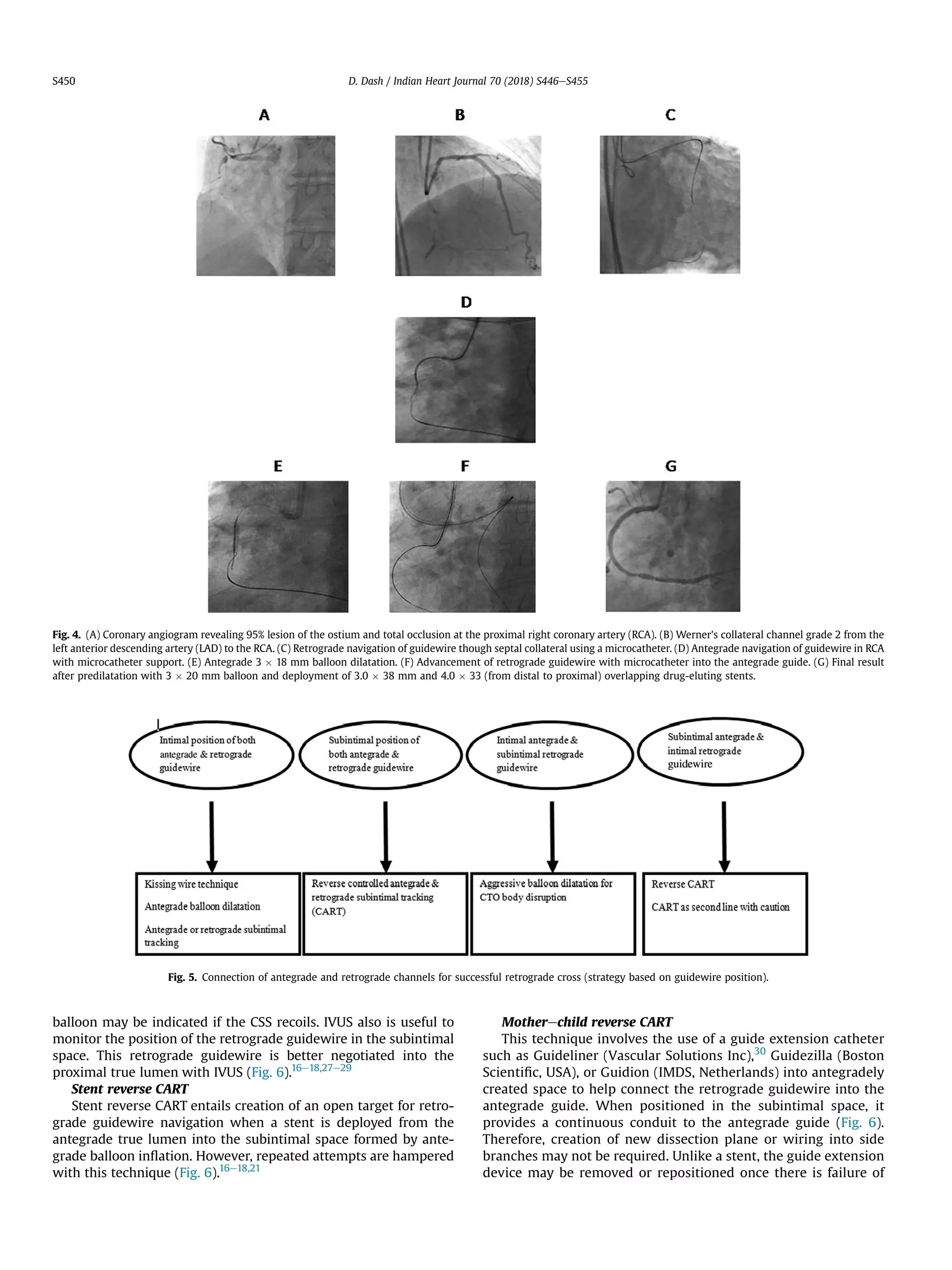 balloon may be indicated if the CSS recoils. IVUS also is useful to
monitor the position of the retrograde guidewire in the subintimal
space. This retrograde guidewire is better negotiated into the
proximal true lumen with IVUS (Fig. 6).16e18,27e29
Stent reverse CART
Stent reverse CART entails creation of an open target for retro-
grade guidewire navigation when a stent is deployed from the
antegrade true lumen into the subintimal space formed by ante-
grade balloon inﬂation. However, repeated attempts are hampered
with this technique (Fig. 6).16e18,21
Motherechild reverse CART
This technique involves the use of a guide extension catheter
such as Guideliner (Vascular Solutions Inc),30
Guidezilla (Boston
Scientiﬁc, USA), or Guidion (IMDS, Netherlands) into antegradely
created space to help connect the retrograde guidewire into the
antegrade guide. When positioned in the subintimal space, it
provides a continuous conduit to the antegrade guide (Fig. 6).
Therefore, creation of new dissection plane or wiring into side
branches may not be required. Unlike a stent, the guide extension
device may be removed or repositioned once there is failure of
Fig. 4. (A) Coronary angiogram revealing 95% lesion of the ostium and total occlusion at the proximal right coronary artery (RCA). (B) Werner's collateral channel grade 2 from the
left anterior descending artery (LAD) to the RCA. (C) Retrograde navigation of guidewire though septal collateral using a microcatheter. (D) Antegrade navigation of guidewire in RCA
with microcatheter support. (E) Antegrade 3 Â 18 mm balloon dilatation. (F) Advancement of retrograde guidewire with microcatheter into the antegrade guide. (G) Final result
after predilatation with 3 Â 20 mm balloon and deployment of 3.0 Â 38 mm and 4.0 Â 33 (from distal to proximal) overlapping drug-eluting stents.
Fig. 5. Connection of antegrade and retrograde channels for successful retrograde cross (strategy based on guidewire position).
D. Dash / Indian Heart Journal 70 (2018) S446eS455S450
 