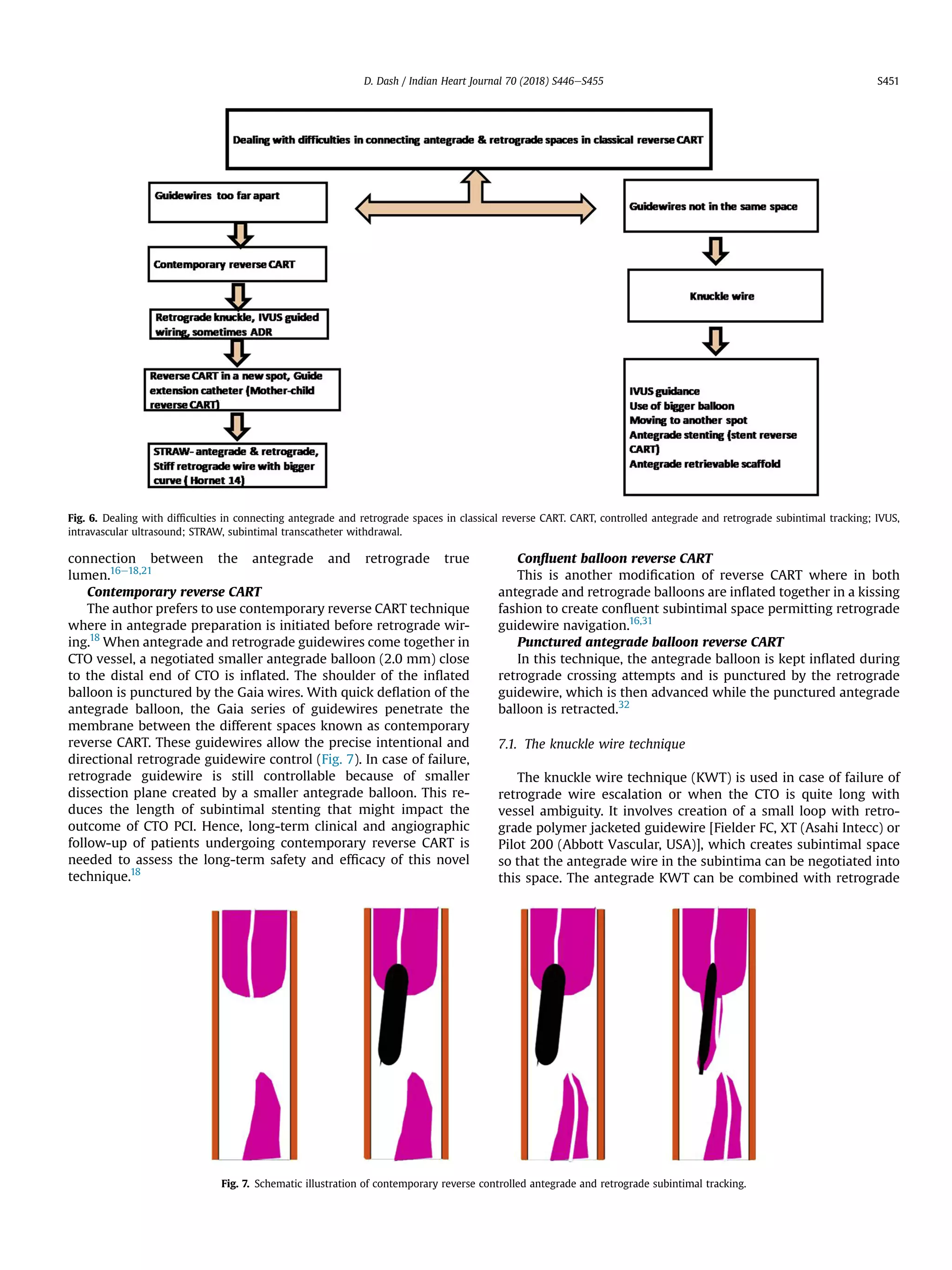 connection between the antegrade and retrograde true
lumen.16e18,21
Contemporary reverse CART
The author prefers to use contemporary reverse CART technique
where in antegrade preparation is initiated before retrograde wir-
ing.18
When antegrade and retrograde guidewires come together in
CTO vessel, a negotiated smaller antegrade balloon (2.0 mm) close
to the distal end of CTO is inﬂated. The shoulder of the inﬂated
balloon is punctured by the Gaia wires. With quick deﬂation of the
antegrade balloon, the Gaia series of guidewires penetrate the
membrane between the different spaces known as contemporary
reverse CART. These guidewires allow the precise intentional and
directional retrograde guidewire control (Fig. 7). In case of failure,
retrograde guidewire is still controllable because of smaller
dissection plane created by a smaller antegrade balloon. This re-
duces the length of subintimal stenting that might impact the
outcome of CTO PCI. Hence, long-term clinical and angiographic
follow-up of patients undergoing contemporary reverse CART is
needed to assess the long-term safety and efﬁcacy of this novel
technique.18
Conﬂuent balloon reverse CART
This is another modiﬁcation of reverse CART where in both
antegrade and retrograde balloons are inﬂated together in a kissing
fashion to create conﬂuent subintimal space permitting retrograde
guidewire navigation.16,31
Punctured antegrade balloon reverse CART
In this technique, the antegrade balloon is kept inﬂated during
retrograde crossing attempts and is punctured by the retrograde
guidewire, which is then advanced while the punctured antegrade
balloon is retracted.32
7.1. The knuckle wire technique
The knuckle wire technique (KWT) is used in case of failure of
retrograde wire escalation or when the CTO is quite long with
vessel ambiguity. It involves creation of a small loop with retro-
grade polymer jacketed guidewire [Fielder FC, XT (Asahi Intecc) or
Pilot 200 (Abbott Vascular, USA)], which creates subintimal space
so that the antegrade wire in the subintima can be negotiated into
this space. The antegrade KWT can be combined with retrograde
Fig. 6. Dealing with difﬁculties in connecting antegrade and retrograde spaces in classical reverse CART. CART, controlled antegrade and retrograde subintimal tracking; IVUS,
intravascular ultrasound; STRAW, subintimal transcatheter withdrawal.
Fig. 7. Schematic illustration of contemporary reverse controlled antegrade and retrograde subintimal tracking.
D. Dash / Indian Heart Journal 70 (2018) S446eS455 S451
 