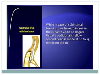 Retrograde cto interv.