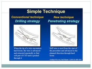 Retrograde cto interv.