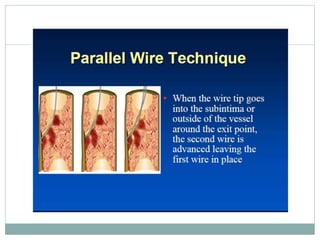 Retrograde cto interv.