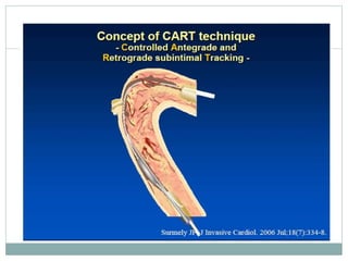 Retrograde cto interv.
