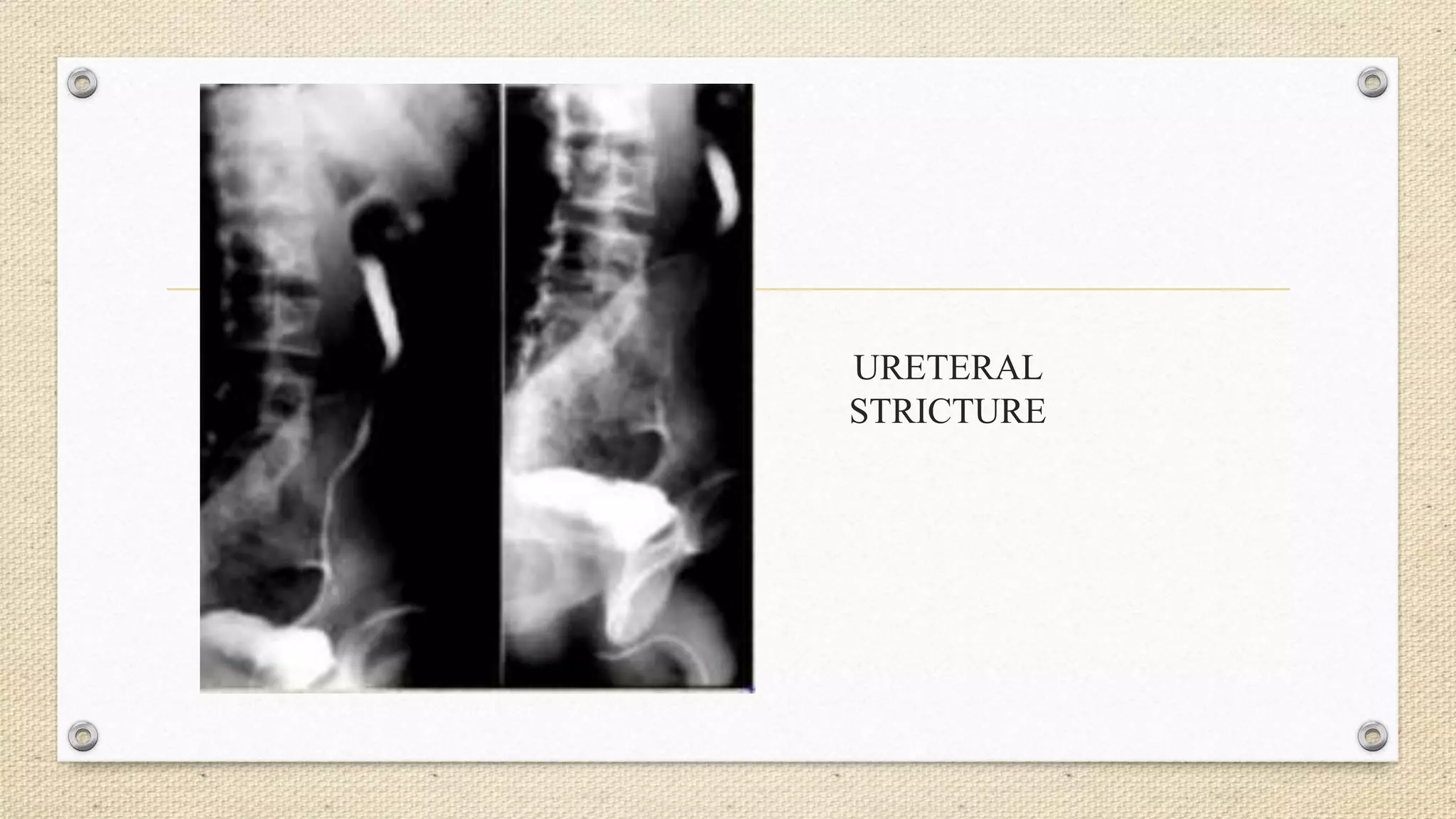 URETERAL
STRICTURE
 