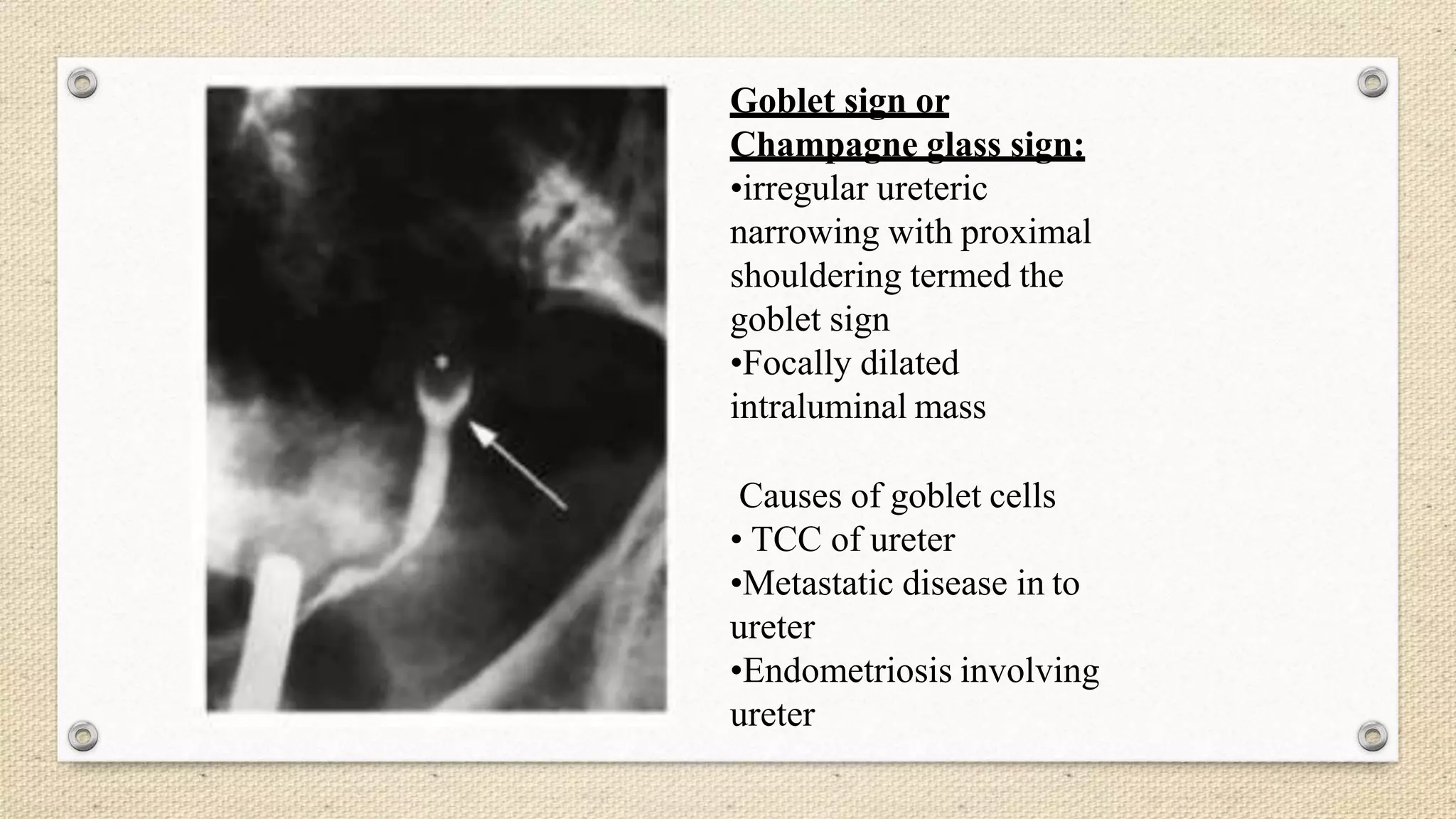 Goblet sign or
Champagne glass sign:
•irregular ureteric
narrowing with proximal
shouldering termed the
goblet sign
•Focally dilated
intraluminal mass
Causes of goblet cells
• TCC of ureter
•Metastatic disease in to
ureter
•Endometriosis involving
ureter
 