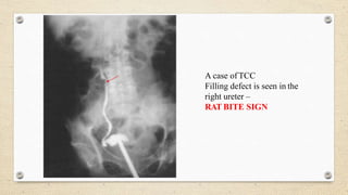 A case ofTCC
Filling defect is seen in the
right ureter –
RAT BITE SIGN
 