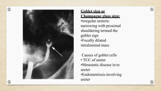 Goblet sign or
Champagne glass sign:
•irregular ureteric
narrowing with proximal
shouldering termed the
goblet sign
•Focally dilated
intraluminal mass
Causes of goblet cells
• TCC of ureter
•Metastatic disease in to
ureter
•Endometriosis involving
ureter
 