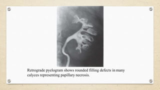 Retrograde pyelogram shows rounded filling defects in many
calyces representing papillary necrosis.
 
