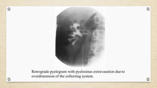 Retrograde pyelogram with pyelosinus extravasation due to
overdistension of the collecting system.
 