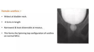 Utricular Cyst Rgu Retrograde urethrography (RGU) and MCU.pptx