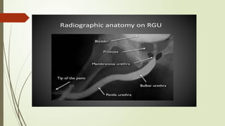 Utricular Cyst Rgu Retrograde urethrography (RGU) and MCU.pptx