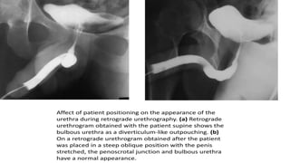Utricular Cyst Rgu Retrograde urethrography (RGU) and MCU.pptx