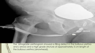 Ir Retrograde Urethrogram Retrograde urethrography (RGU) and MCU.pptx