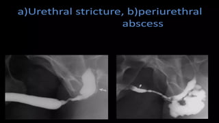 Utricular Cyst Rgu Retrograde urethrography (RGU) and MCU.pptx