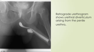 Ir Retrograde Urethrogram Retrograde urethrography (RGU) and MCU.pptx