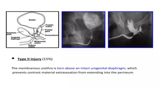 Utricular Cyst Rgu Retrograde urethrography (RGU) and MCU.pptx