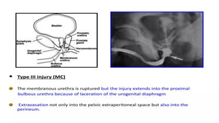 Utricular Cyst Rgu Retrograde urethrography (RGU) and MCU.pptx