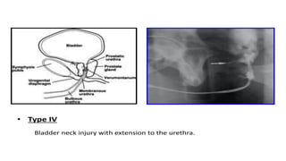 Retrogram Retrogrphy Retrograde urethrography (RGU) and MCU.pptx