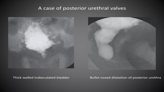 Retrogram Retrogrphy Retrograde urethrography (RGU) and MCU.pptx