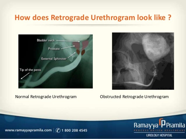 retrograde urethroscopy 6 638