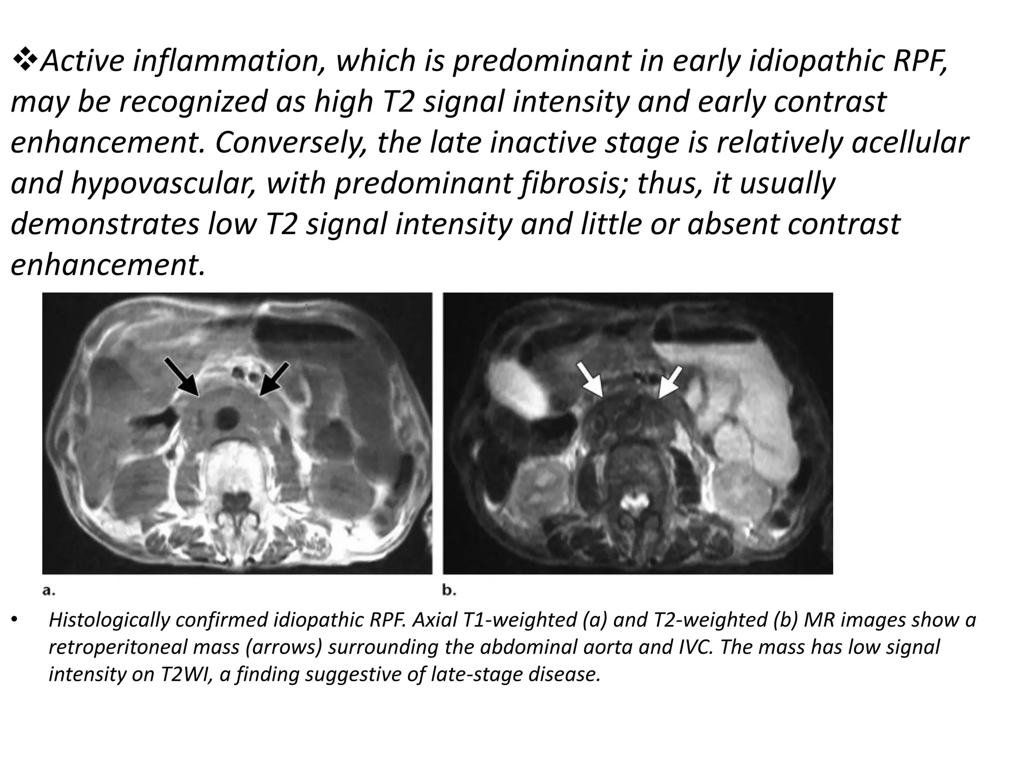 Axial MRI scans showing retroperitoneal mass encasing the aorta and IVC in retroperitoneal fibrosis